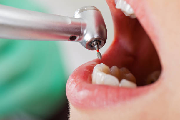 Best Emergency Tooth Extraction in Concord, MI